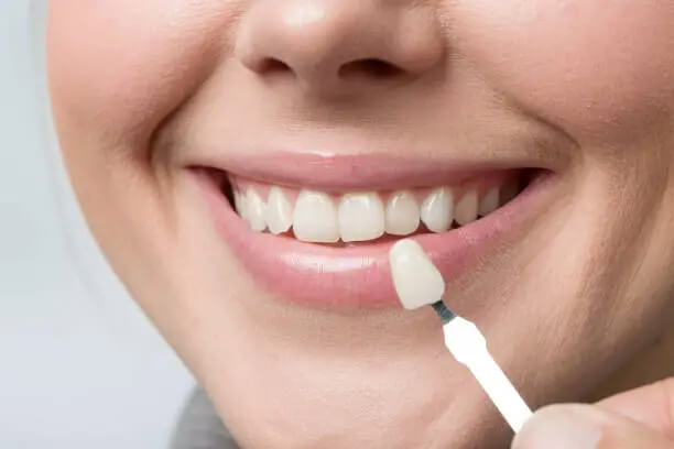 Carillas Dentales Carillas Dentales